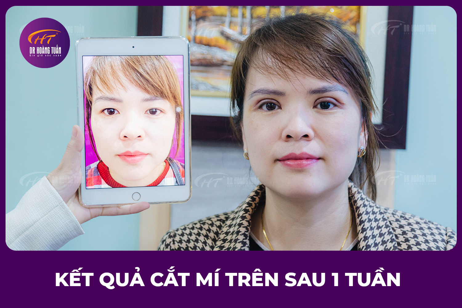 Cắt mí trên đẹp tự nhiên